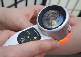 Strach z melanomu přivedl na bezplatné vyšetření téměř 1800 lidí