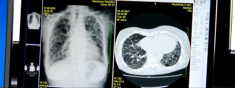 Týden idiopatické plicní fibrózy. Pardubická nemocnice nabídne plicní vyšetření